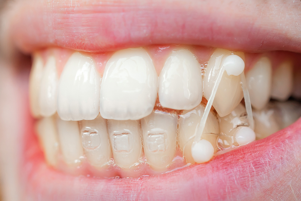 54%OFF!】 歯科矯正 顎間ゴム ゴムかけ 歯並び エラスティック ワイヤー インビザライン