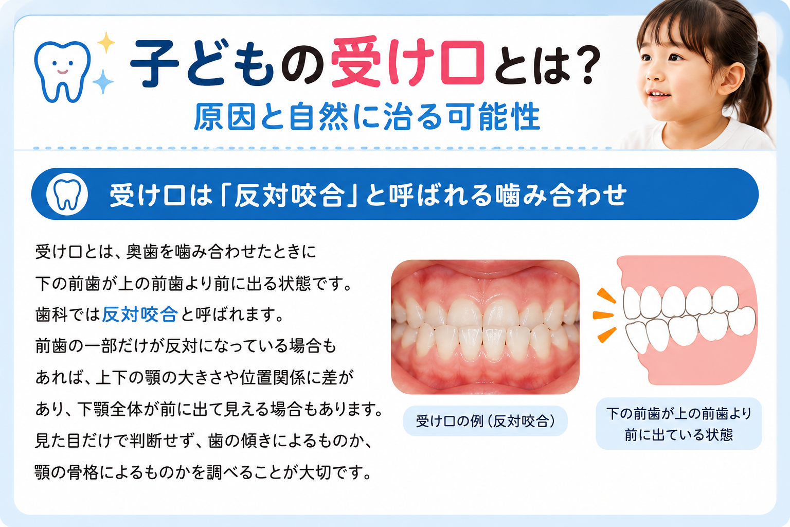子どもの受け口